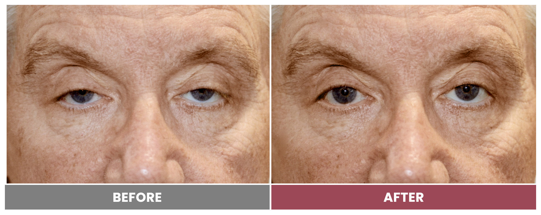 PTOSIS REPAIR - Case 40